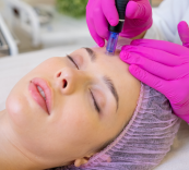 Microneedling